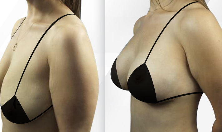 Rediscover Your Shape: Mommy Makeover in Miami post thumbnail image