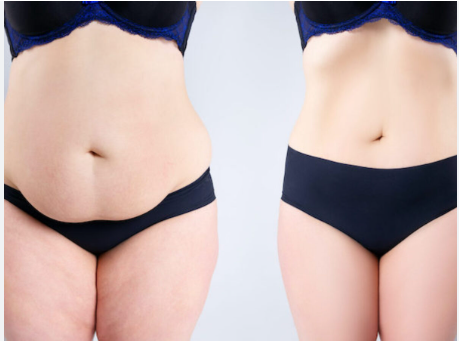 Elevate Your Self-Image with Tummy Tuck in Miami post thumbnail image