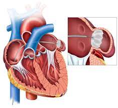 Enhancing Stroke Prevention: The Watchman Procedure Explained post thumbnail image