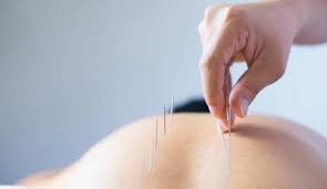 Discover the Healing Power of Acupuncture in Coquitlam and Port Moody post thumbnail image